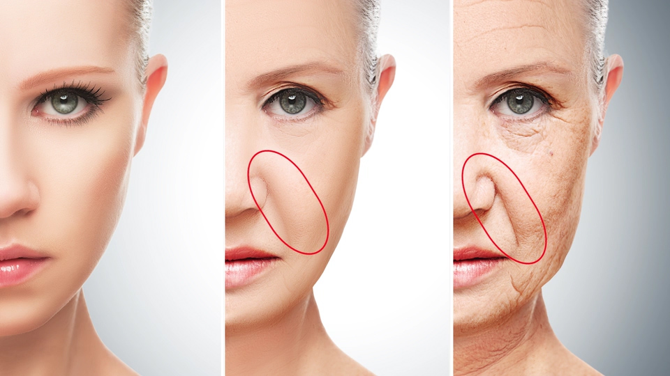 Do Nasolabial Folds Age You