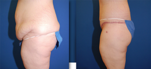 contouring bariatric