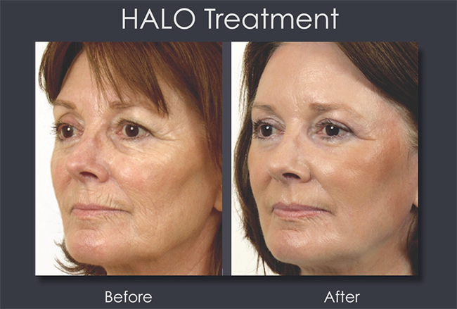 HALO: Shedding New Light On Your Skin | The Plastic Surgery Channel
