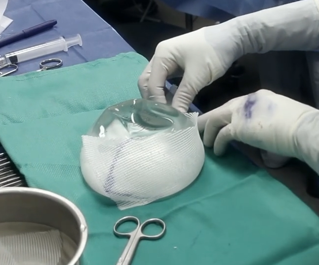 Breast Implant With Internal Bra Technique