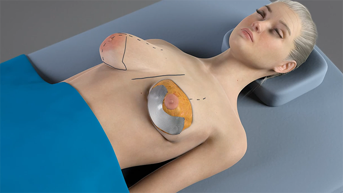 Will Breast Implants Shift If You Flex Your Chest?