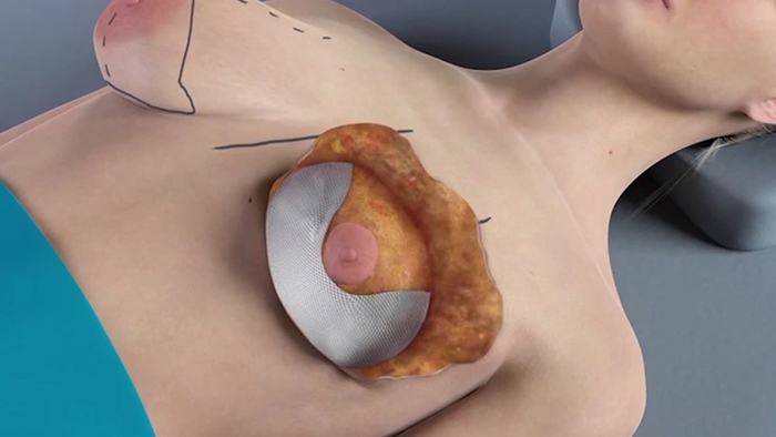 Internal Bra Technique with Galaflex HD - Plastic Surgery, Medspa