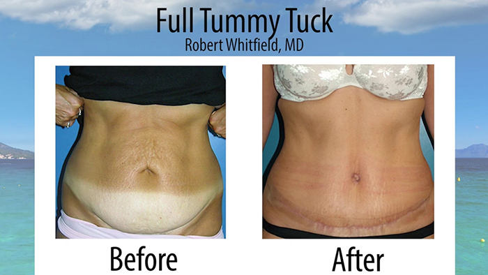 What Is a Mini Tummy Tuck & How Does It Work?