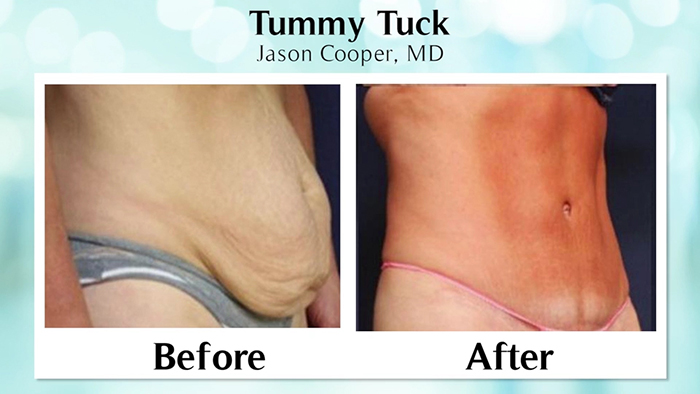 Mini or Full, Which Tummy Tuck is Right for You? - The Plastic Surgery  Channel