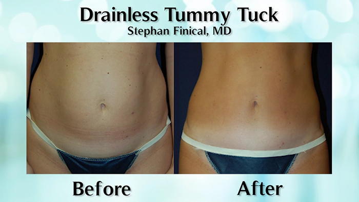Drainless Tummy Tuck for Faster Recovery with Dr. Ennis