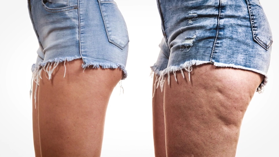 Cellulite Treatments that Work - The Plastic Surgery Channel