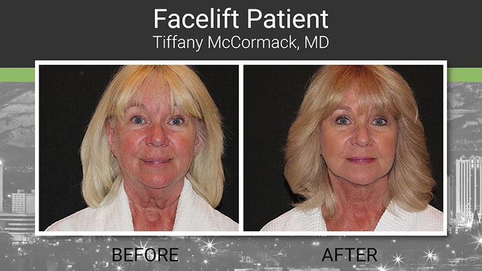 Facelift patient - Dr. McCormack.